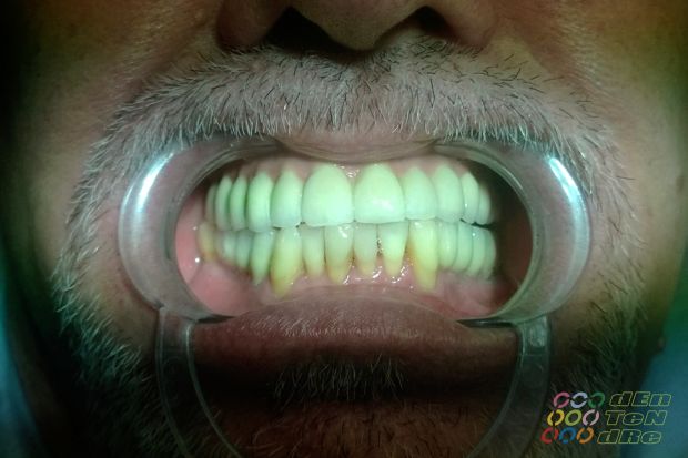 Full upper arch rehabilitation on intraocclusal screw retained implants, biscuit try in and fit appointment.-4