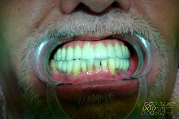 Full upper arch rehabilitation on intraocclusal screw retained implants, biscuit try in and fit appointment.-5