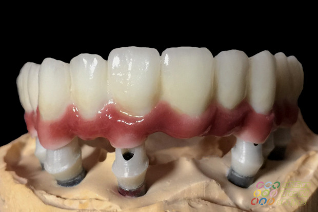 Porcelain covered full span bridge of zirconium on custom made abutments of zirconium with porcelain gingiva-2