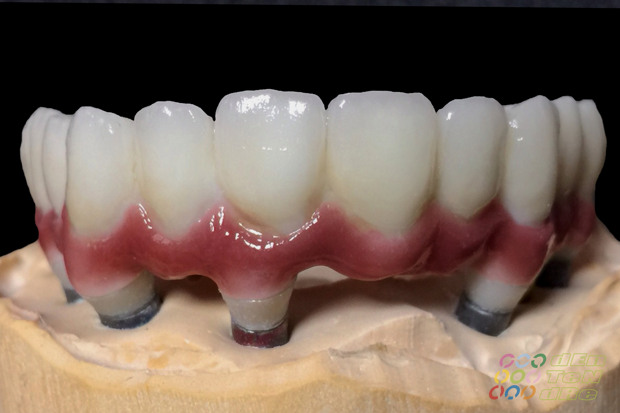 Porcelain covered full span bridge of zirconium on custom made abutments of zirconium with porcelain gingiva