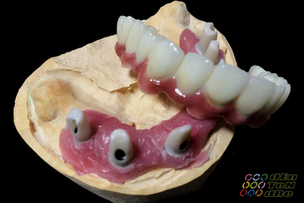 Porcelain covered full span bridge of zirconium on custom made abutments of zirconium with porcelain gingiva-3