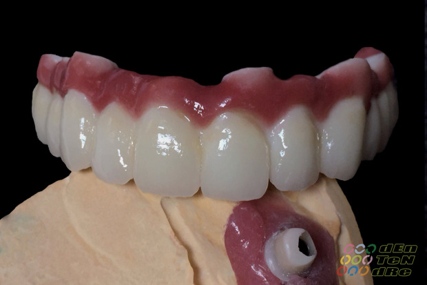 Porcelain covered full span bridge of zirconium on custom made abutments of zirconium with porcelain gingiva-4