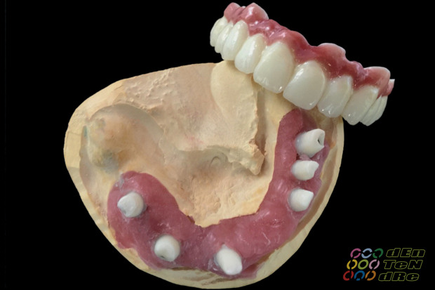 Porcelain covered full span bridge of zirconium on custom made abutments of zirconium with porcelain gingiva-5