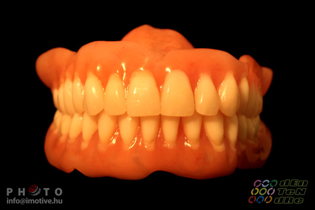 Upper and lower full dentures