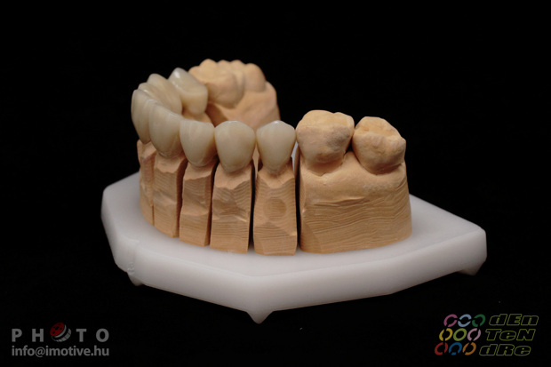 Upper zirconium crowns