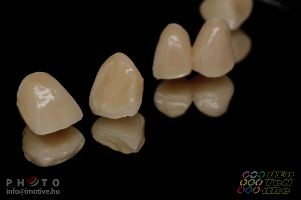 Upper zirconium crowns-2