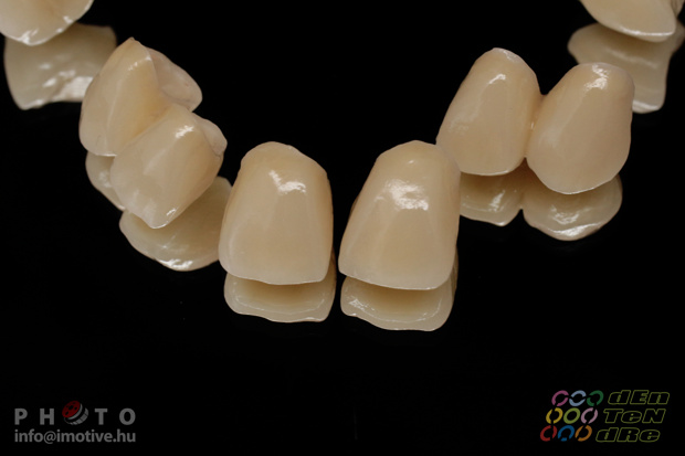 Upper zirconium crowns-3
