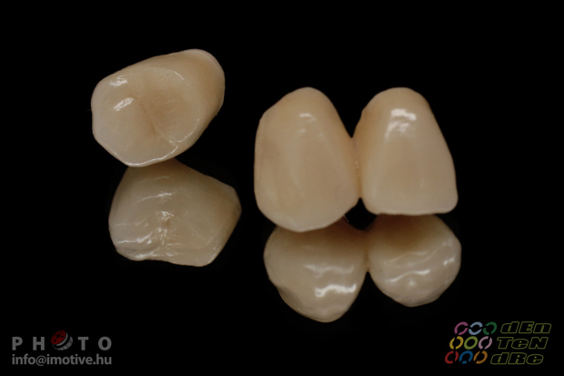 Upper zirconium crowns-4