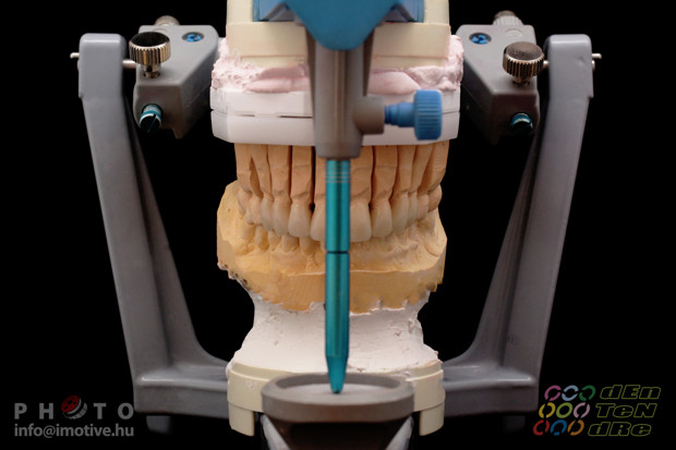 Upper zirconium crowns-5