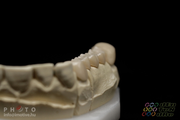5 units zirconium frame with bracing, before covering.-5