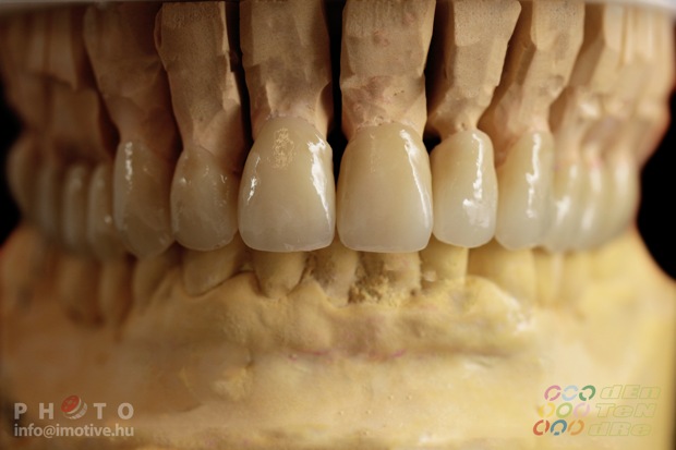 Porcelain covered zirconium crowns.