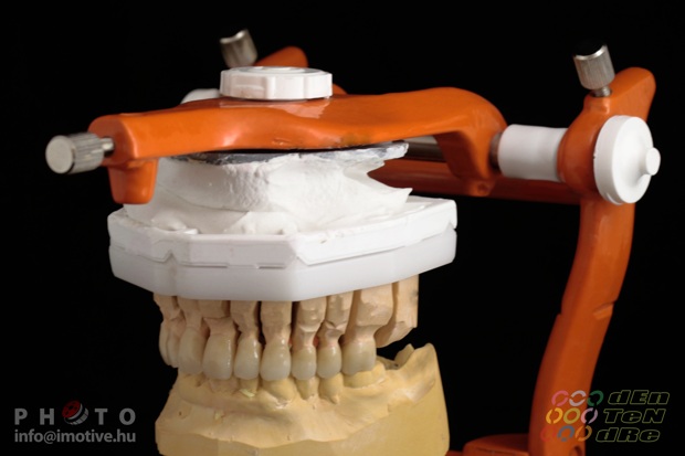Porcelain covered zirconium crowns.-2