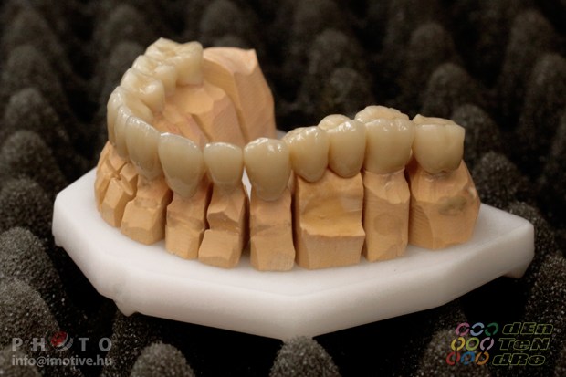 Porcelain covered zirconium crowns.-3