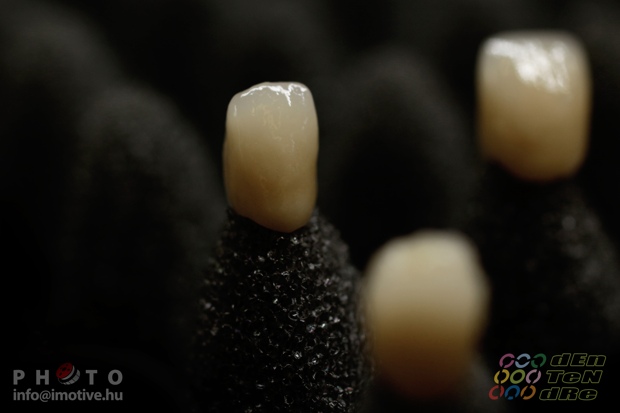 Porcelain covered zirconium crowns.-4