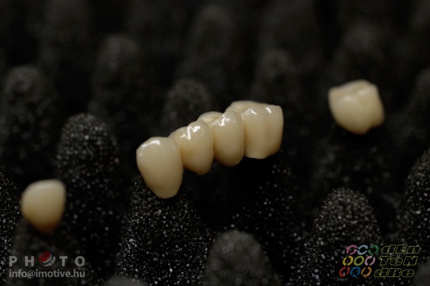 Porcelain covered zirconium crowns.-5