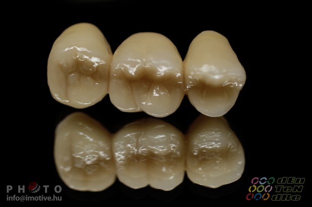 Porcelain covered zirconium bridge.