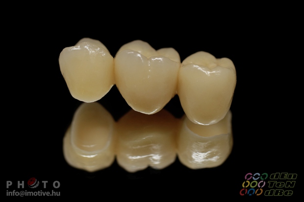 Porcelain covered zirconium bridge.-2