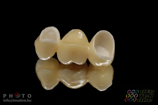 Porcelain covered zirconium bridge.-3