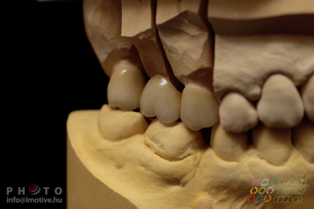 Porcelain covered zirconium bridge.-4