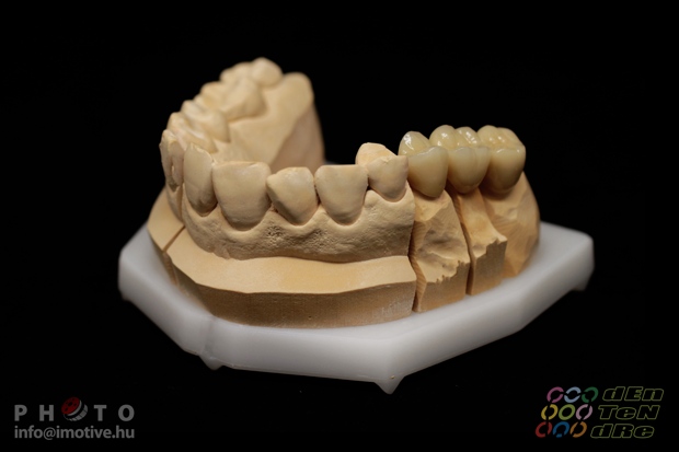 Porcelain covered zirconium bridge.-5