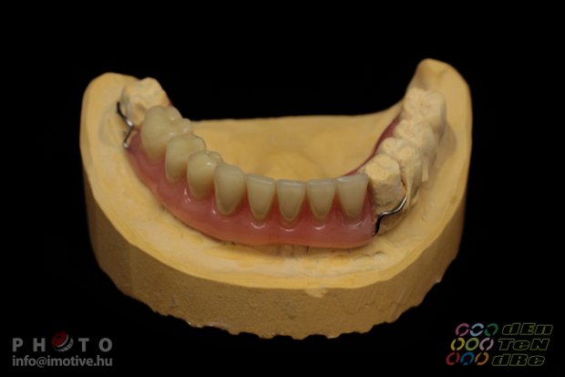 Temporary denture