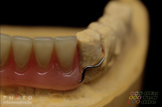 Temporary denture-2