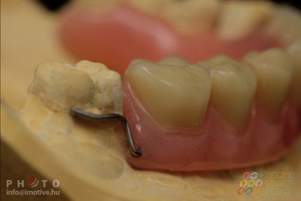 Temporary denture-3