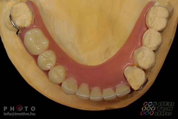 Temporary denture-4