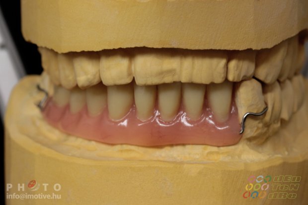 Temporary denture-5