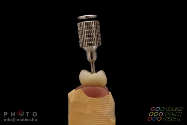 Screw retained metal-fused-to-porcelain solo crown