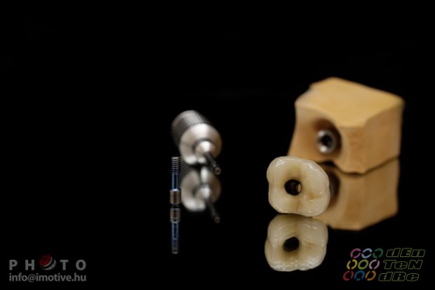 Screw retained metal-fused-to-porcelain solo crown-2