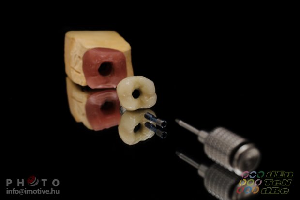 Screw retained metal-fused-to-porcelain solo crown-3