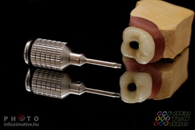 Screw retained metal-fused-to-porcelain solo crown-4