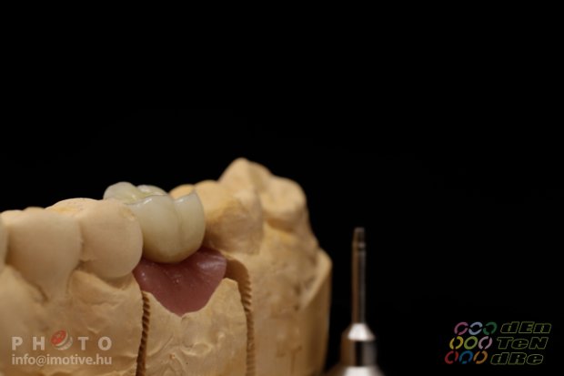 Screw retained metal-fused-to-porcelain solo crown-5