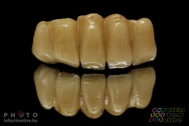 Cement retained porcelain bonded zirconium bridge on individualized abutments and a solo screw retained porcelain bonded zirconium crown.