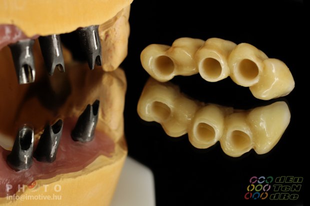 Cement retained porcelain bonded zirconium bridge on individualized abutments and a solo screw retained porcelain bonded zirconium crown.-2
