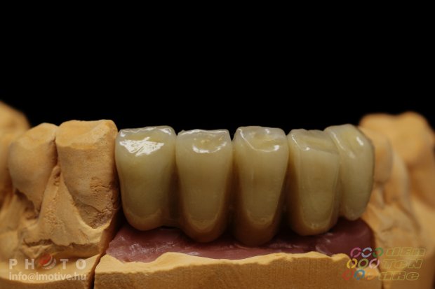 Cement retained porcelain bonded zirconium bridge on individualized abutments and a solo screw retained porcelain bonded zirconium crown.-3