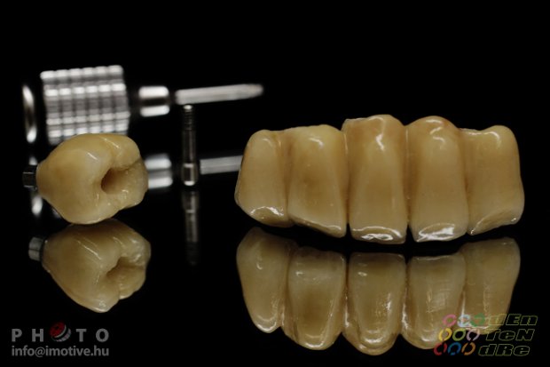 Cement retained porcelain bonded zirconium bridge on individualized abutments and a solo screw retained porcelain bonded zirconium crown.-4