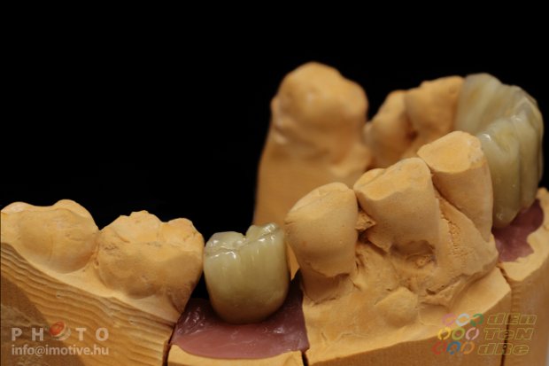 Cement retained porcelain bonded zirconium bridge on individualized abutments and a solo screw retained porcelain bonded zirconium crown.-5