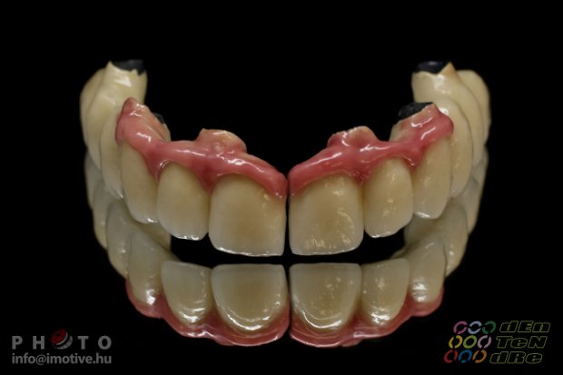 Upper dental bridge of metal-fused-to-porcelain with porcelain gingiva.-2