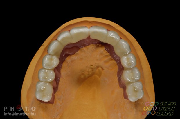 Upper dental bridge of metal-fused-to-porcelain with porcelain gingiva.-4