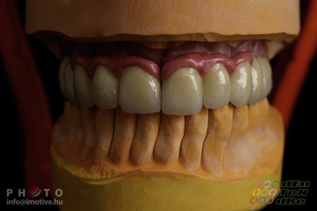 Upper dental bridge of metal-fused-to-porcelain with porcelain gingiva.-5