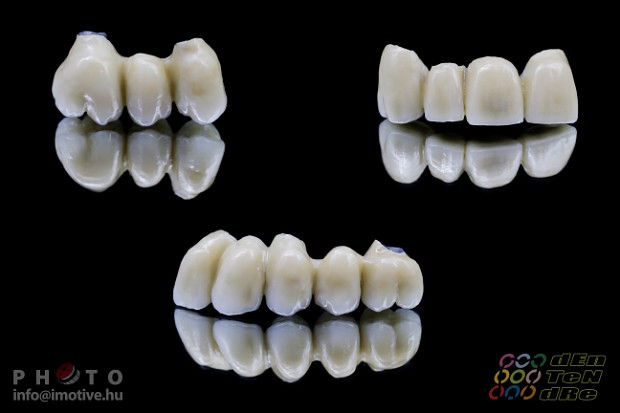 Upper and lower long-span PBC bridges on implants.