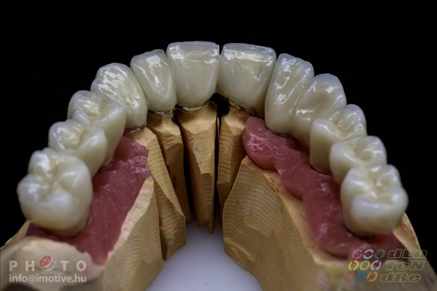 Upper and lower long-span PBC bridges on implants.-2