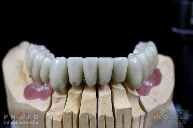 Upper and lower long-span PBC bridges on implants.-3