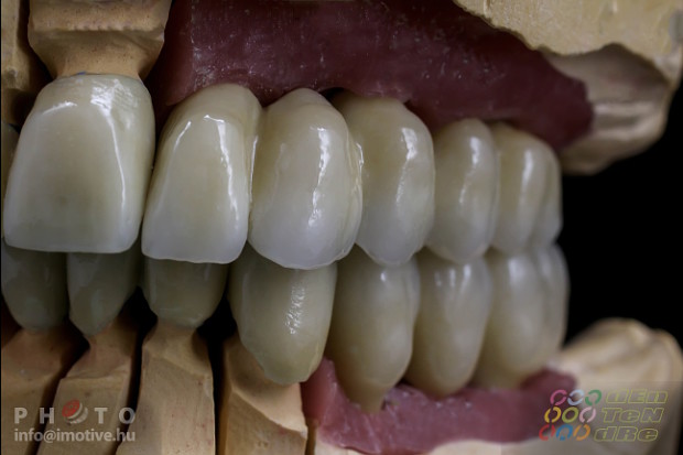 Upper and lower long-span PBC bridges on implants.-4