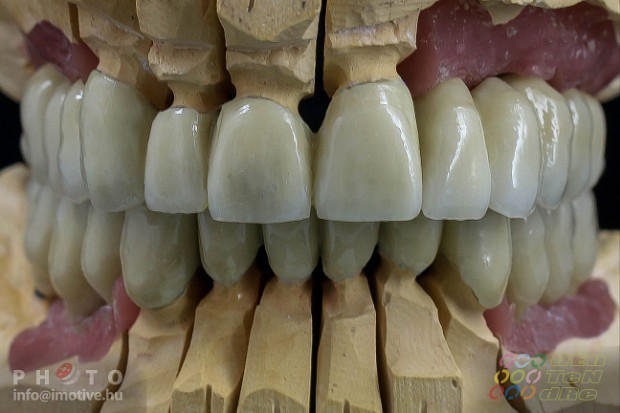 Upper and lower long-span PBC bridges on implants.-5