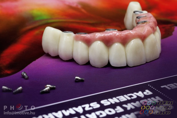 Intraocclusal screw retained upper long span bridge of PBC with gingiva made of ceramic.