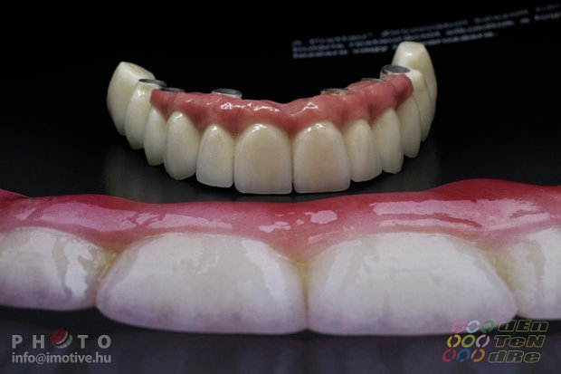 Intraocclusal screw retained upper long span bridge of PBC with gingiva made of ceramic.-2