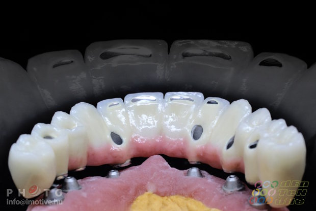 Intraocclusal screw retained upper long span bridge of PBC with gingiva made of ceramic.-3